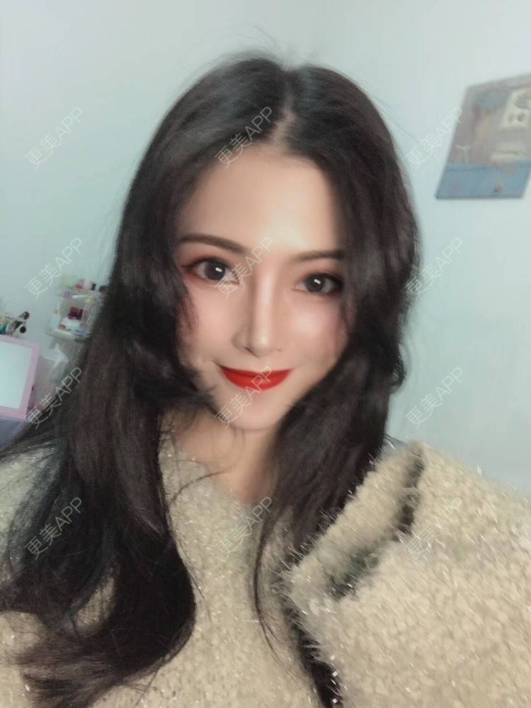 更美 - 西瓜不懂柠檬的酸√按的鼻部膨体假体取出经验 | 鼻形态修复 | 鼻中隔软骨隆鼻 | 鼻部硅胶假体取出 | 膨体隆鼻 | 硅胶隆鼻 | 鼻部膨体假体取出 | 肋软骨隆鼻 | 人工骨隆鼻 | 耳软骨隆鼻 | 南宁