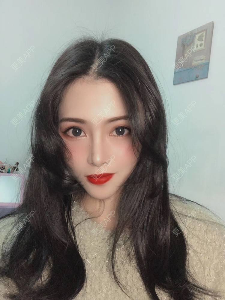 更美 - 西瓜不懂柠檬的酸√按的鼻部膨体假体取出经验 | 鼻形态修复 | 鼻中隔软骨隆鼻 | 鼻部硅胶假体取出 | 膨体隆鼻 | 硅胶隆鼻 | 鼻部膨体假体取出 | 肋软骨隆鼻 | 人工骨隆鼻 | 耳软骨隆鼻 | 南宁