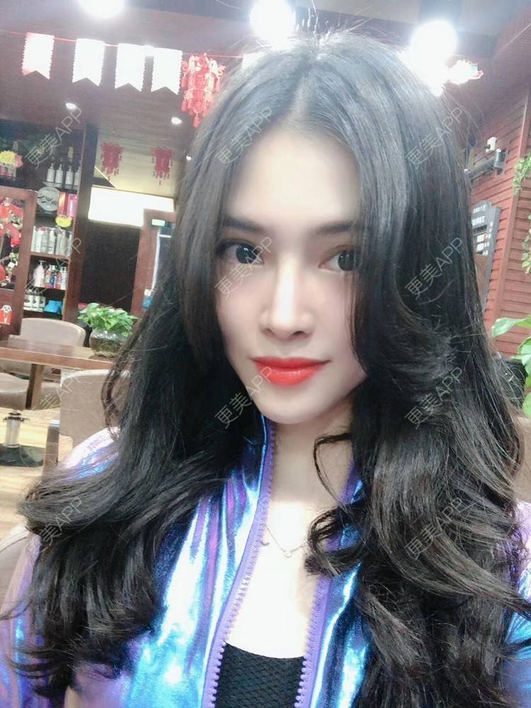 更美 - 西瓜不懂柠檬的酸√按的鼻部膨体假体取出经验 | 视频日记 | 鼻形态修复 | 鼻中隔软骨隆鼻 | 鼻部硅胶假体取出 | 膨体隆鼻 | 硅胶隆鼻 | 鼻部膨体假体取出 | 肋软骨隆鼻 | 人工骨隆鼻 | 耳软骨隆鼻 | 南宁