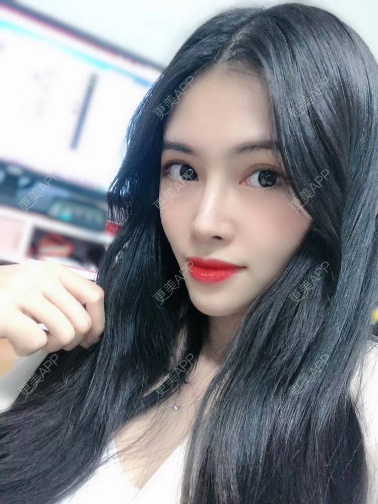 更美 - 西瓜不懂柠檬的酸√按的鼻部膨体假体取出经验 | 视频日记 | 鼻形态修复 | 鼻中隔软骨隆鼻 | 鼻部硅胶假体取出 | 膨体隆鼻 | 硅胶隆鼻 | 鼻部膨体假体取出 | 肋软骨隆鼻 | 人工骨隆鼻 | 耳软骨隆鼻 | 南宁