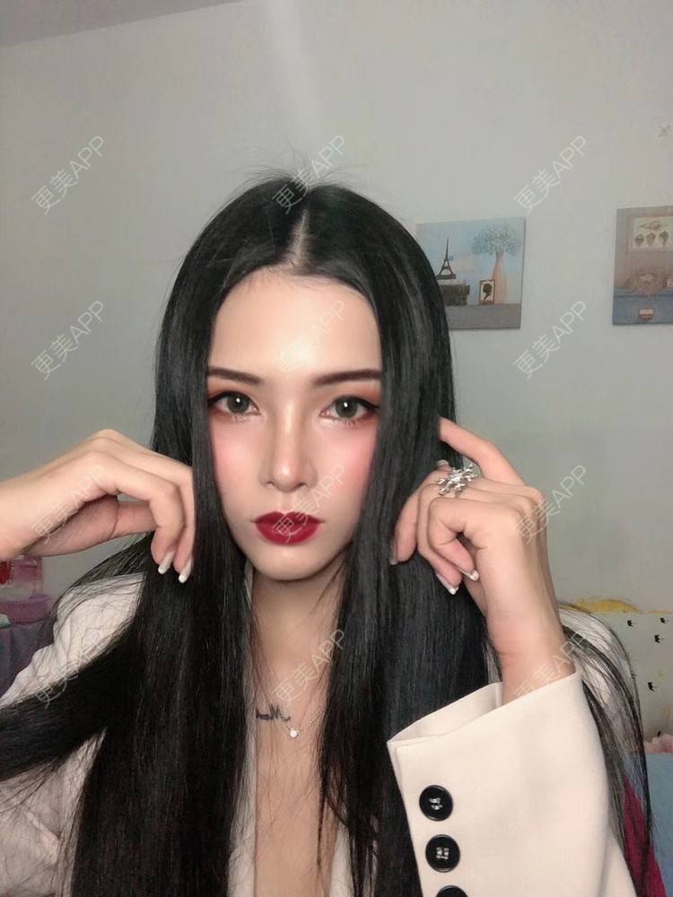 更美 - 西瓜不懂柠檬的酸√按的鼻部膨体假体取出经验 | 视频日记 | 鼻形态修复 | 鼻中隔软骨隆鼻 | 鼻部硅胶假体取出 | 膨体隆鼻 | 硅胶隆鼻 | 鼻部膨体假体取出 | 肋软骨隆鼻 | 人工骨隆鼻 | 耳软骨隆鼻 | 南宁