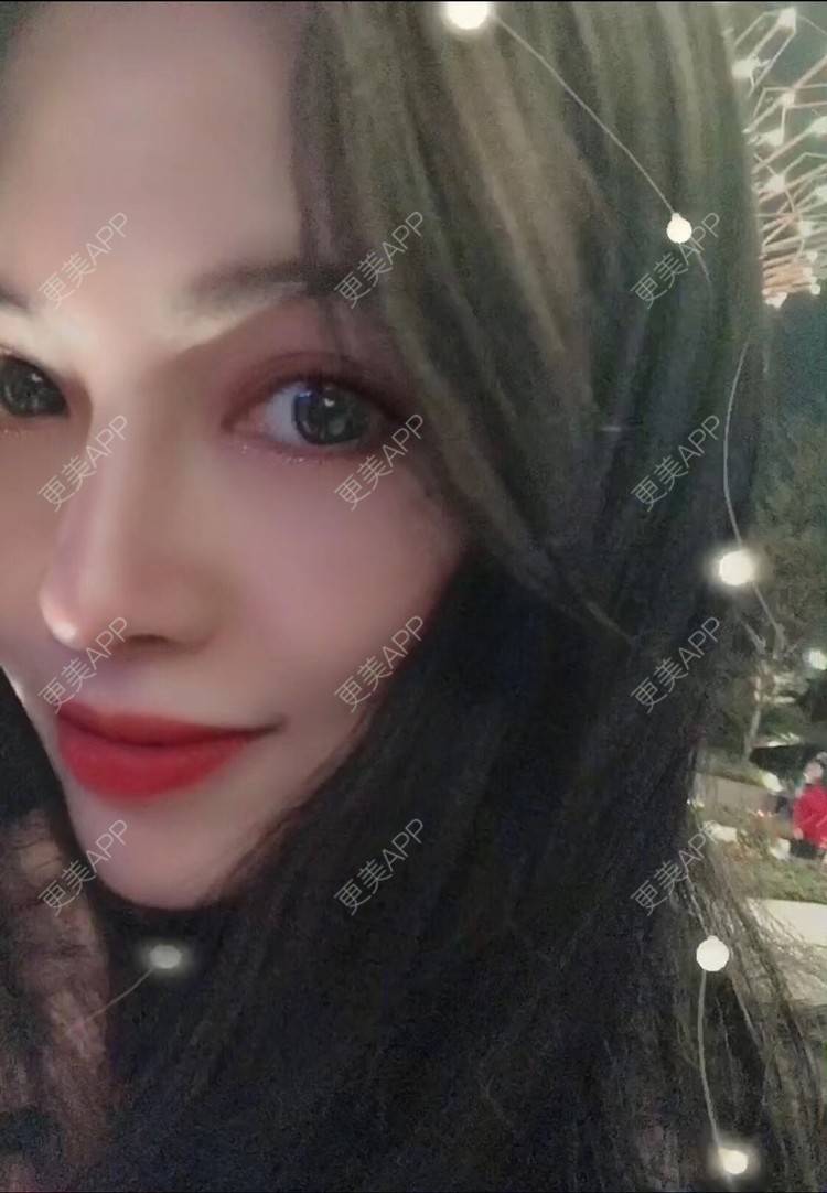 更美 - 西瓜不懂柠檬的酸√按的鼻部膨体假体取出经验 | 视频日记 | 鼻形态修复 | 鼻中隔软骨隆鼻 | 鼻部硅胶假体取出 | 膨体隆鼻 | 硅胶隆鼻 | 鼻部膨体假体取出 | 肋软骨隆鼻 | 人工骨隆鼻 | 耳软骨隆鼻 | 南宁