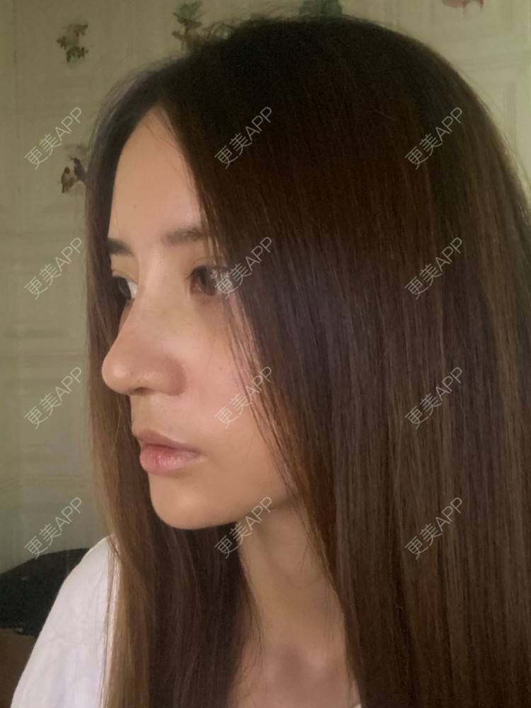 更美 - 小君君！的隆鼻经验 | 隆鼻 | 肋软骨隆鼻 | 自体软骨垫鼻尖 | 鼻部多项 | 自体肋软骨垫鼻基底 | 重庆 | 鼻中隔软骨垫鼻头