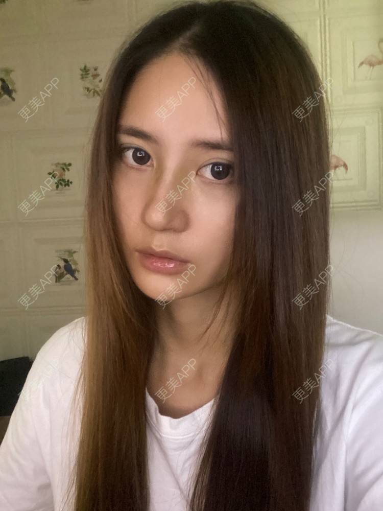 更美 - 小君君！的隆鼻经验 | 隆鼻 | 肋软骨隆鼻 | 自体软骨垫鼻尖 | 鼻部多项 | 自体肋软骨垫鼻基底 | 重庆 | 鼻中隔软骨垫鼻头