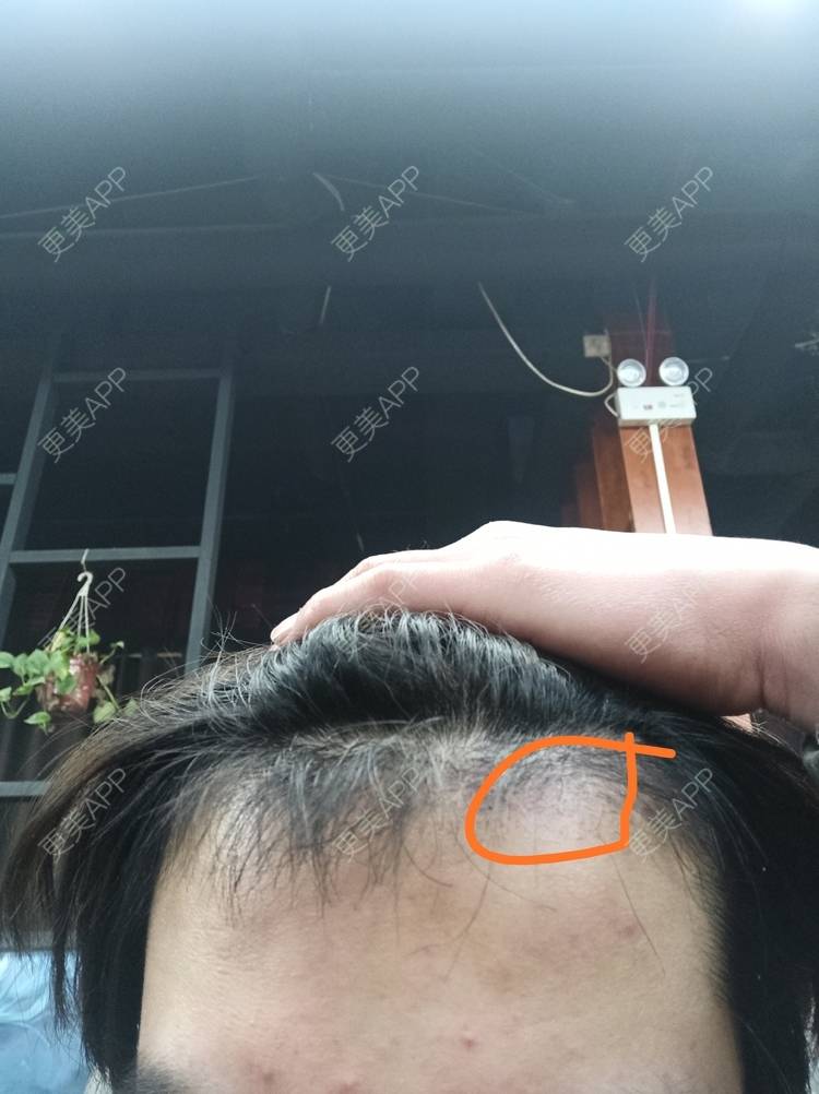 更美 - 更MEI团草的面部脱毛经验 | 面部脱毛 | 菏泽