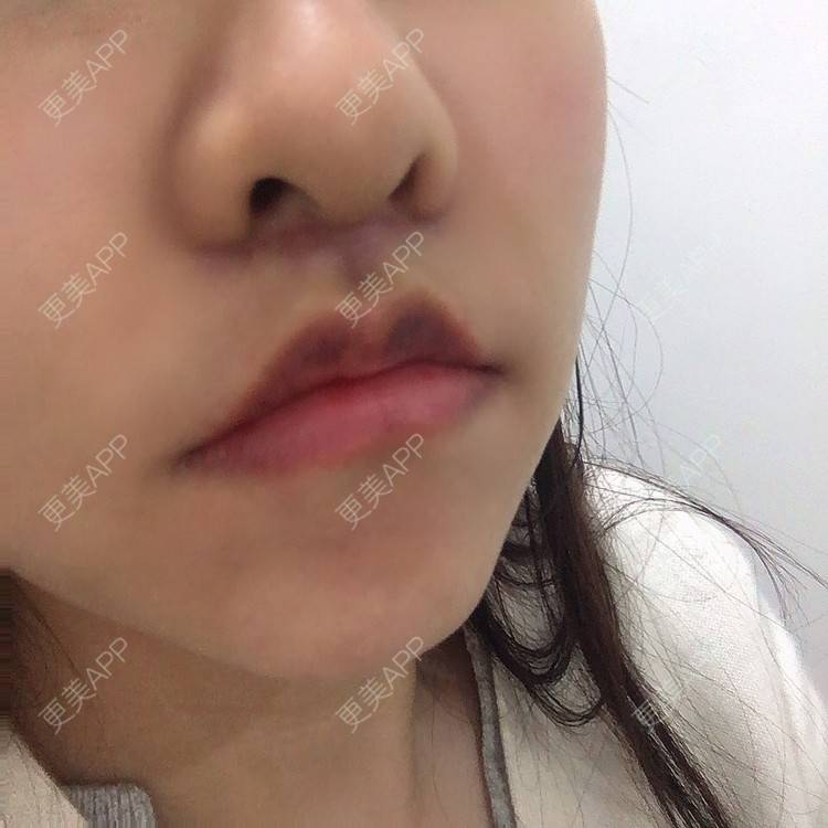 更美 - 阿狸的城堡🏰的唇腭裂修复经验 | 唇腭裂修复 | 蚌埠 | 人中缩短