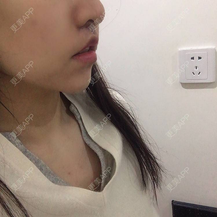 更美 - 阿狸的城堡🏰的唇腭裂修复经验 | 唇腭裂修复 | 蚌埠 | 人中缩短