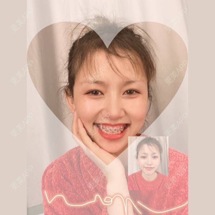 更美 - Lisa baby的光子嫩肤经验 | 光子嫩肤 | 昆明