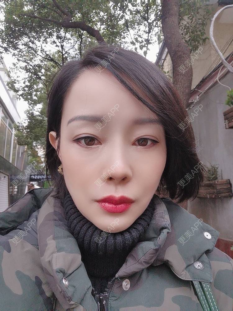 更美 - 🐷🐮仔仔仔的热玛吉经验 | 上海 | 热玛吉