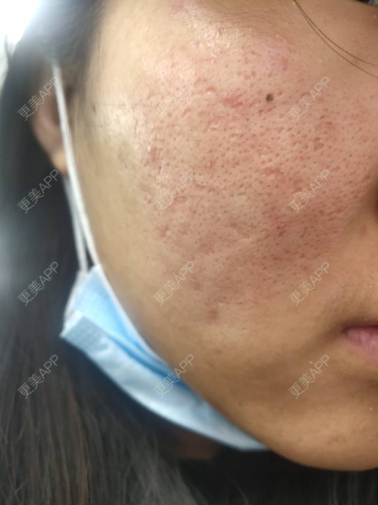 更美 - 更美用户82FaqFotX5的点阵激光经验 | 北京 | 点阵激光