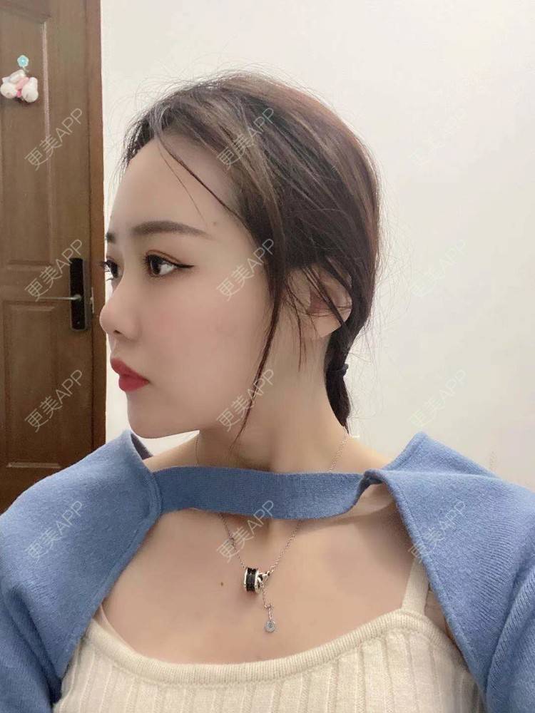 更美 - 更美用户v4cAbrKvHI的光纤瘦脸经验 | 北京 | 光纤溶脂 | 光纤瘦脸