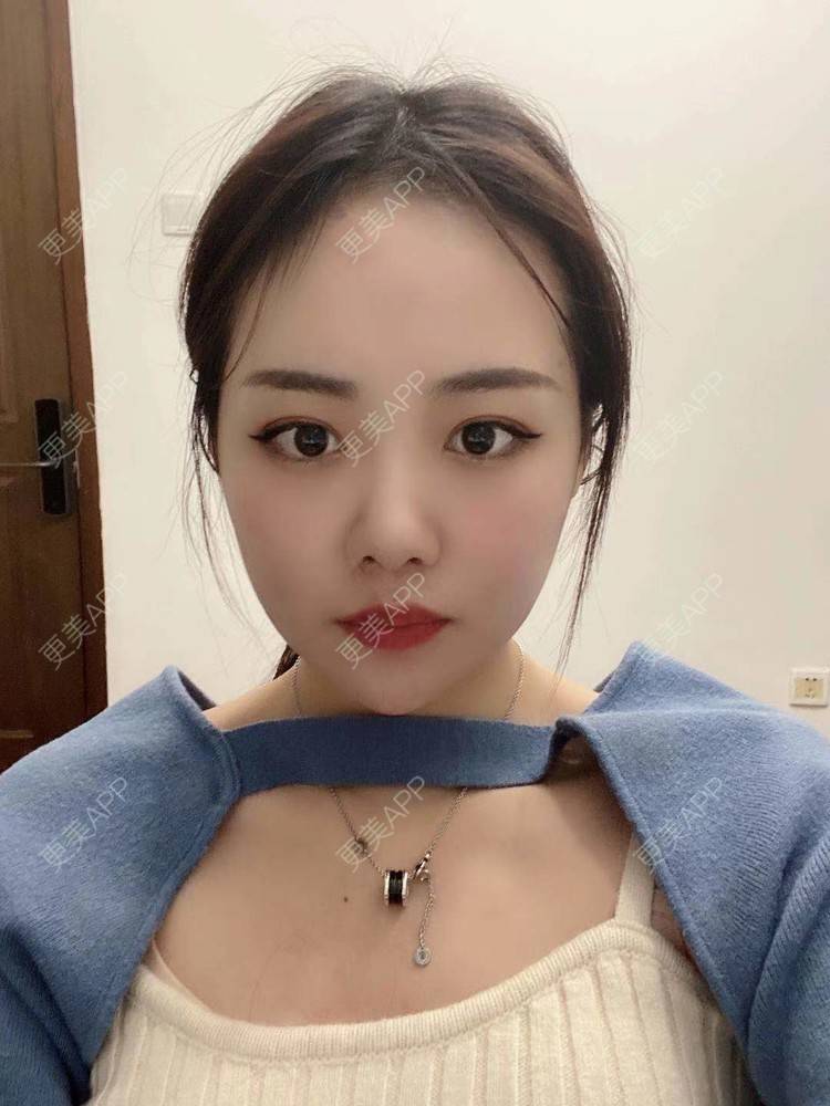 更美 - 更美用户v4cAbrKvHI的光纤瘦脸经验 | 北京 | 光纤溶脂 | 光纤瘦脸