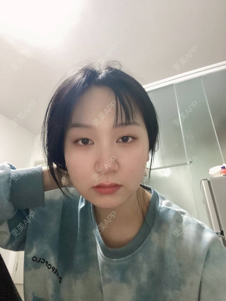 更美 - 更美用户91nh9woCEF的光纤溶脂经验 | 北京 | 光纤溶脂
