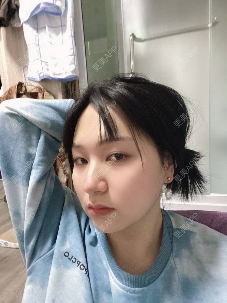 更美 - 更美用户91nh9woCEF的光纤溶脂经验 | 北京 | 光纤溶脂