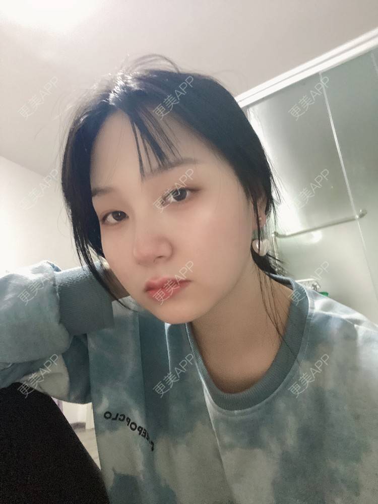 更美 - 更美用户91nh9woCEF的光纤溶脂经验 | 北京 | 光纤溶脂