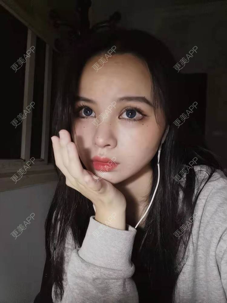 更美 - 耿直girl在线的鼻部多项经验 | 肋软骨隆鼻 | 耳软骨隆鼻 | 鼻翼缩小 | 鼻小柱延长 | 鼻部多项 | 自体软骨垫鼻尖 | 膨体隆鼻 | 鼻中隔软骨垫鼻头 | 鼻中隔软骨隆鼻 | 垫鼻尖 | 人工骨隆鼻