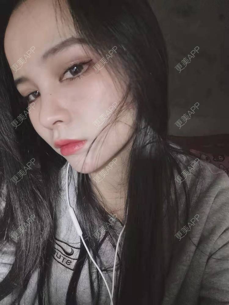 更美 - 耿直girl在线的鼻部多项经验 | 肋软骨隆鼻 | 耳软骨隆鼻 | 鼻翼缩小 | 鼻小柱延长 | 鼻部多项 | 自体软骨垫鼻尖 | 膨体隆鼻 | 鼻中隔软骨垫鼻头 | 鼻中隔软骨隆鼻 | 垫鼻尖 | 人工骨隆鼻