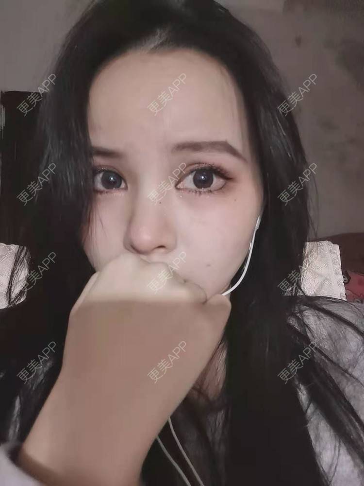 更美 - 耿直girl在线的鼻部多项经验 | 肋软骨隆鼻 | 耳软骨隆鼻 | 鼻翼缩小 | 鼻小柱延长 | 鼻部多项 | 自体软骨垫鼻尖 | 膨体隆鼻 | 鼻中隔软骨垫鼻头 | 鼻中隔软骨隆鼻 | 垫鼻尖 | 人工骨隆鼻