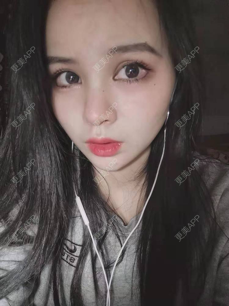 更美 - 耿直girl在线的鼻部多项经验 | 肋软骨隆鼻 | 耳软骨隆鼻 | 鼻翼缩小 | 鼻小柱延长 | 鼻部多项 | 自体软骨垫鼻尖 | 膨体隆鼻 | 鼻中隔软骨垫鼻头 | 鼻中隔软骨隆鼻 | 垫鼻尖 | 人工骨隆鼻