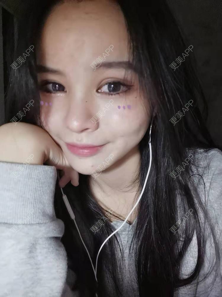 更美 - 耿直girl在线的鼻部多项经验 | 肋软骨隆鼻 | 耳软骨隆鼻 | 鼻翼缩小 | 鼻小柱延长 | 鼻部多项 | 自体软骨垫鼻尖 | 膨体隆鼻 | 鼻中隔软骨垫鼻头 | 鼻中隔软骨隆鼻 | 垫鼻尖 | 人工骨隆鼻