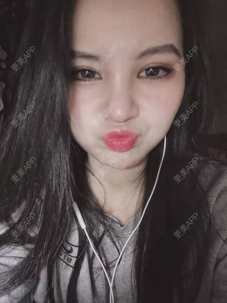 更美 - 耿直girl在线的鼻部多项经验 | 肋软骨隆鼻 | 耳软骨隆鼻 | 鼻翼缩小 | 鼻小柱延长 | 鼻部多项 | 自体软骨垫鼻尖 | 膨体隆鼻 | 鼻中隔软骨垫鼻头 | 鼻中隔软骨隆鼻 | 垫鼻尖 | 人工骨隆鼻