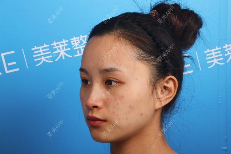 更美 - 更美用户Vge2UlmhsJ的黄金微针经验 | 黄金微针