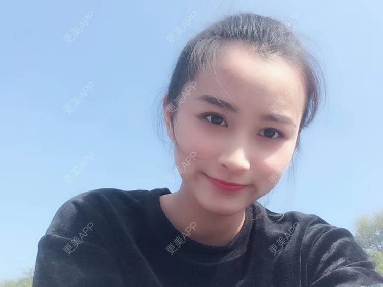 更美 - 更美用户Vge2UlmhsJ的黄金微针经验 | 黄金微针