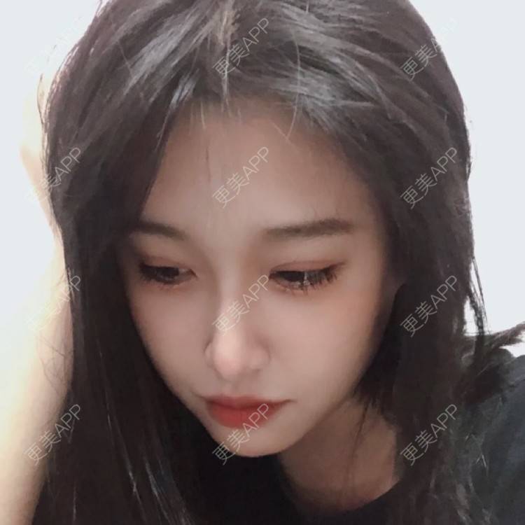 更美 - 更美用户iDGQvjbrET的眼皮下垂矫正经验 | 杭州 | 上眼睑去脂 | 眼睑下至 | 眼皮下垂矫正