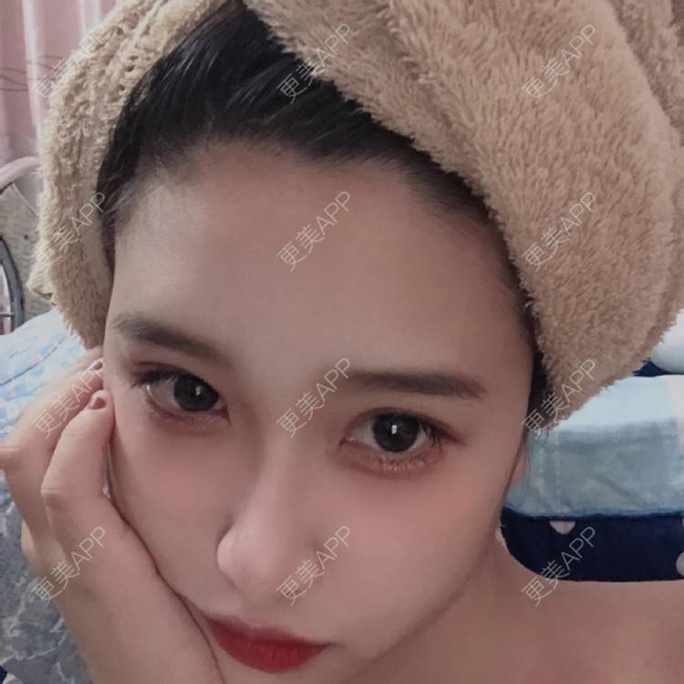更美 - 更美用户iDGQvjbrET的眼皮下垂矫正经验 | 杭州 | 上眼睑去脂 | 眼睑下至 | 眼皮下垂矫正