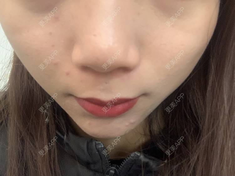 更美 - 更美用户6N19FJQyKl的黄金微针经验 | 广州 | 黄金微针