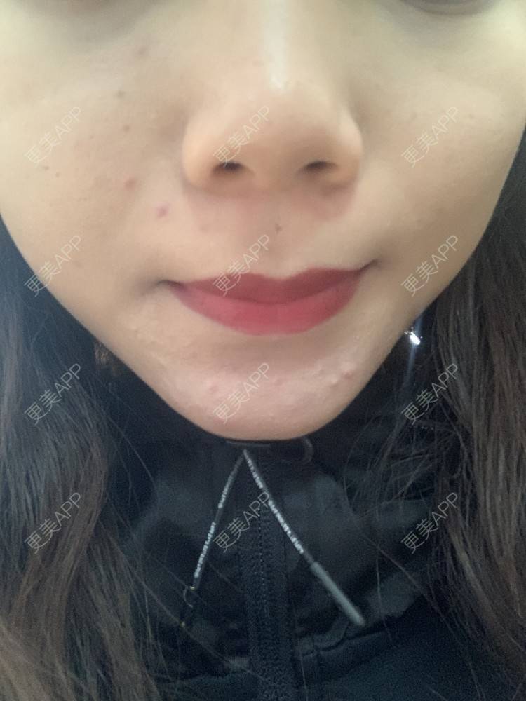 更美 - 更美用户6N19FJQyKl的黄金微针经验 | 广州 | 黄金微针