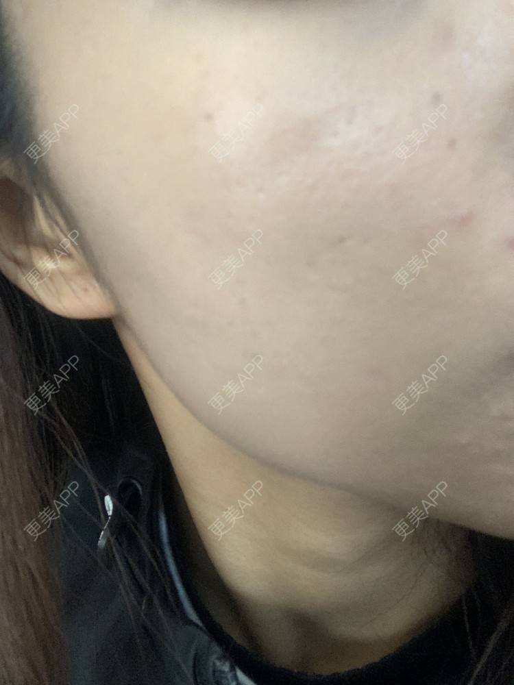 更美 - 更美用户6N19FJQyKl的黄金微针经验 | 广州 | 黄金微针