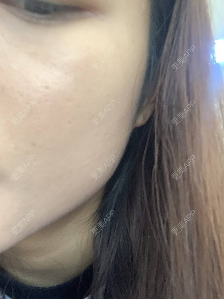 更美 - 更美用户6N19FJQyKl的黄金微针经验 | 广州 | 黄金微针