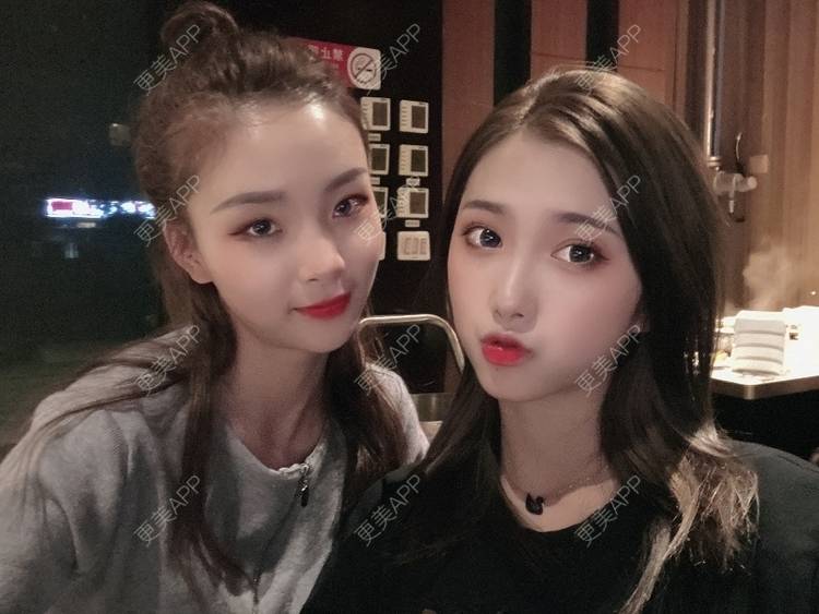 更美 - 奥特星人的祛眼袋经验 | 郑州 | 祛眼袋