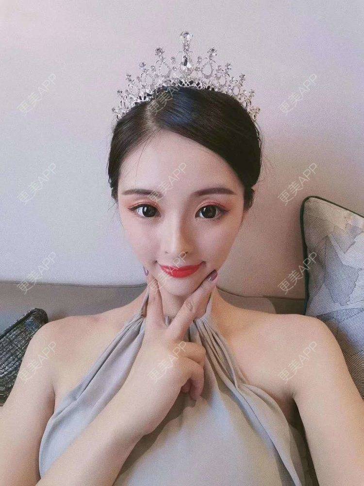 更美 - 更美用户x4LwfANdSq的垫眉弓经验 | 郑州 | 视频日记 | 垫眉弓