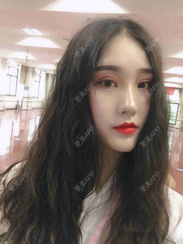 更美 - <ωèι倁の亽格○渡的全切双眼皮经验 | 视频日记 | 全切双眼皮 | 武汉