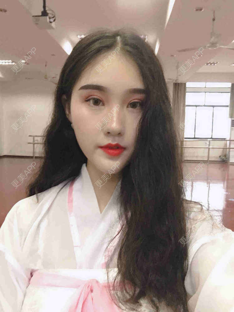 更美 - <ωèι倁の亽格○渡的全切双眼皮经验 | 视频日记 | 全切双眼皮 | 武汉