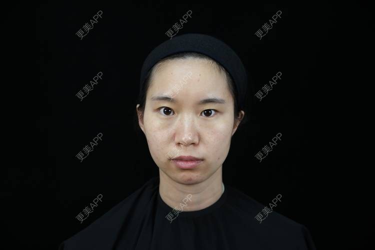 更美 - 孤影不多就我一个鹿的玻尿酸下巴经验 | 北京 | 玻尿酸下巴