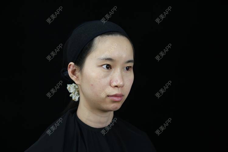 更美 - 孤影不多就我一个鹿的玻尿酸下巴经验 | 北京 | 玻尿酸下巴