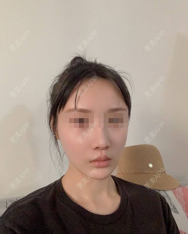 更美 - 更美用户DLi7HL09O1的人中缩短经验 | 广州 | 人中缩短