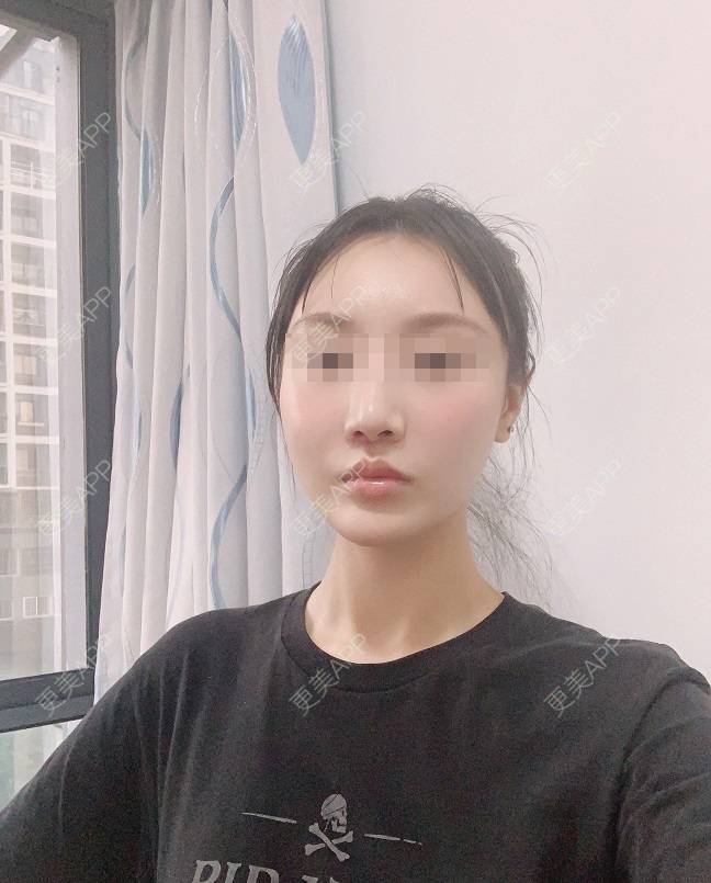 更美 - 更美用户DLi7HL09O1的人中缩短经验 | 广州 | 人中缩短
