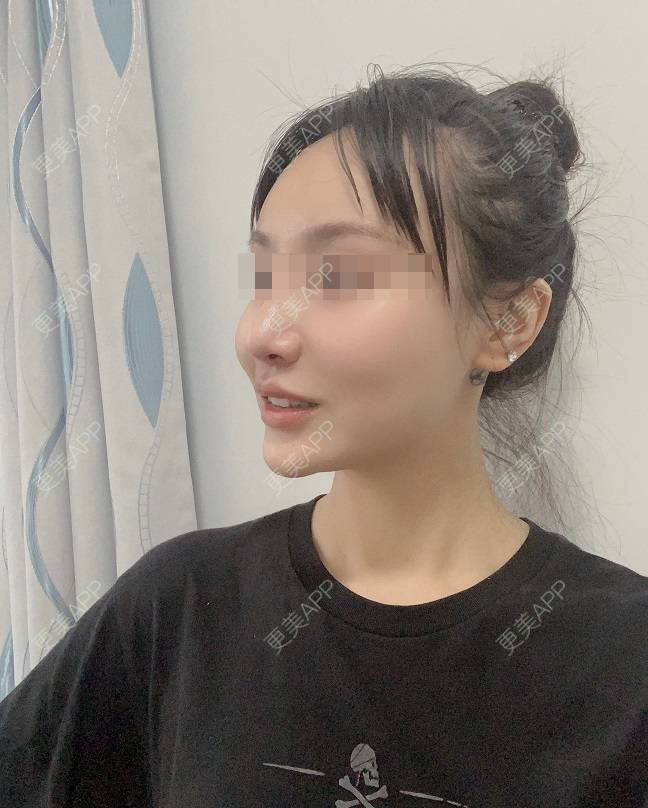更美 - 更美用户DLi7HL09O1的人中缩短经验 | 广州 | 人中缩短