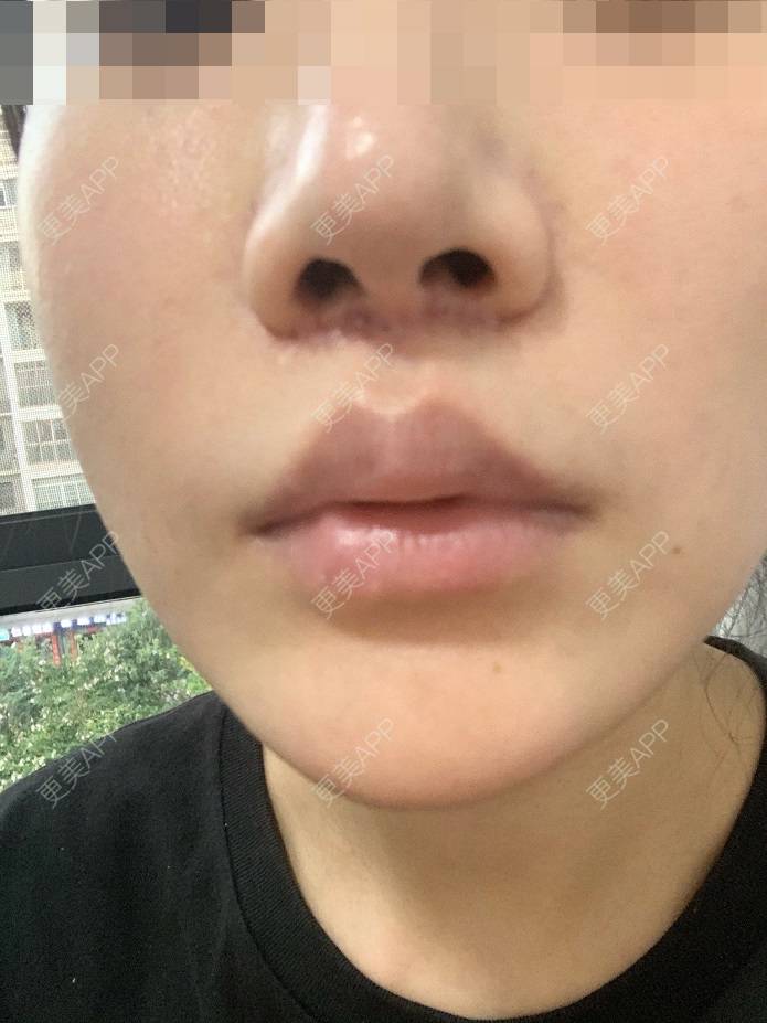 更美 - 更美用户DLi7HL09O1的人中缩短经验 | 广州 | 人中缩短