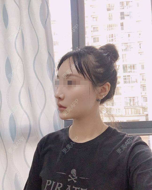 更美 - 更美用户DLi7HL09O1的人中缩短经验 | 广州 | 人中缩短
