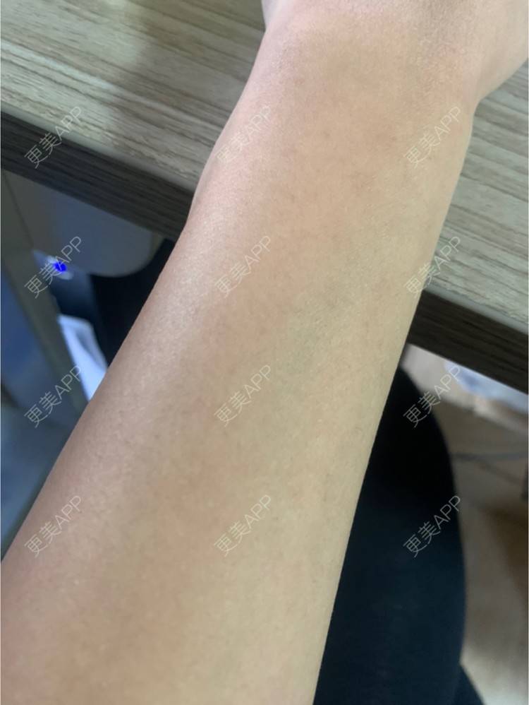 更美 - 更美用户6N19FJQyKl的大腿脱毛经验 | 广州 | 大腿脱毛