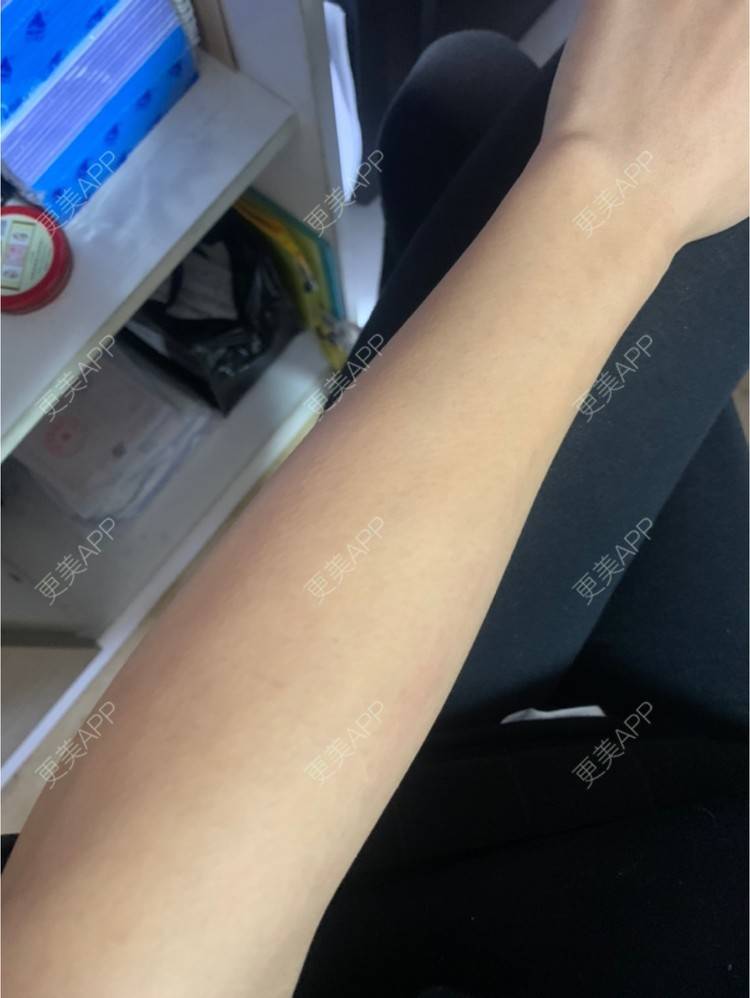 更美 - 更美用户6N19FJQyKl的大腿脱毛经验 | 广州 | 大腿脱毛