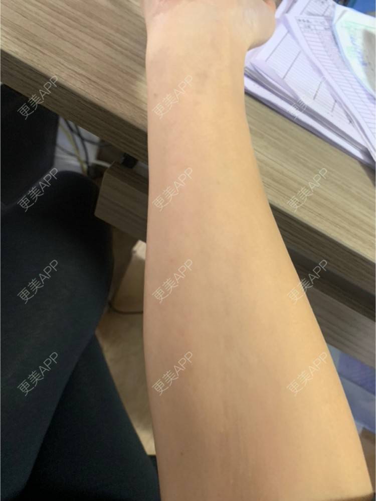更美 - 更美用户6N19FJQyKl的大腿脱毛经验 | 广州 | 大腿脱毛