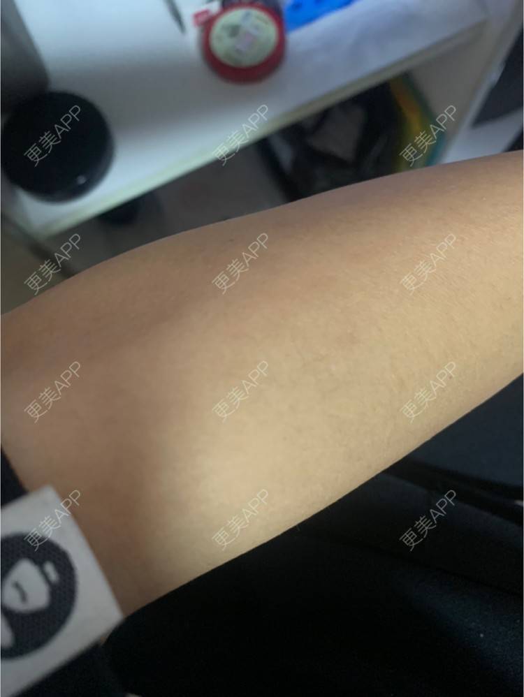 更美 - 更美用户6N19FJQyKl的大腿脱毛经验 | 广州 | 大腿脱毛