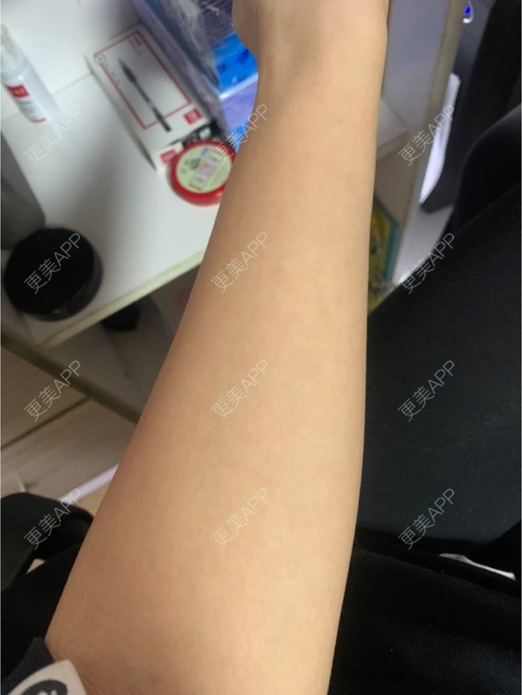 更美 - 更美用户6N19FJQyKl的大腿脱毛经验 | 广州 | 大腿脱毛