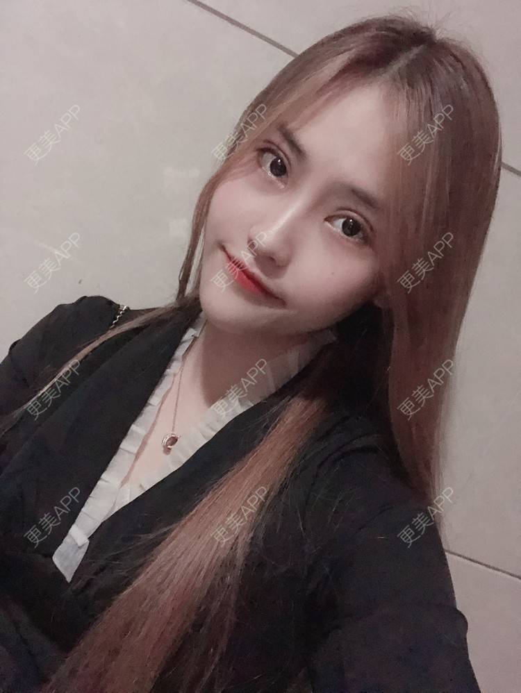 更美 - 小小丽莉的全切双眼皮经验 | 深圳 | 全切双眼皮